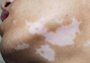 白癜风5 白癜风5