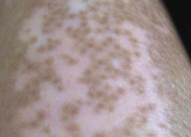 白癜风7 白癜风7